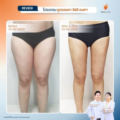 รีวิวก่อนหลัง ดูดไขมันขา 360 องศา 7