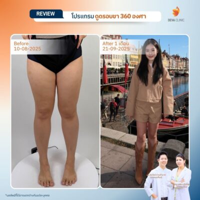 รีวิวดูดไขมันขาตะเกียบ 13