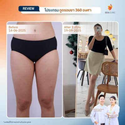 รีวิวดูดไขมันขาใหญ่กรรมพันธุ์ before after 22