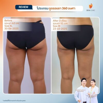 รีวิวดูดไขมันขาตะเกียบ 12