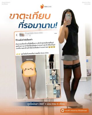 รีวิวดูดไขมันขาตะเกียบ บีต้า