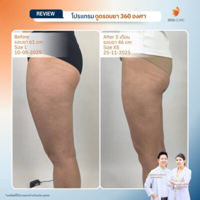 รีวิวก่อนหลัง ดูดไขมันใต้ก้น 6