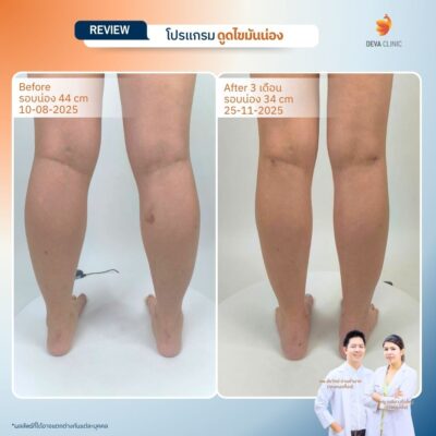 รีวิวก่อนหลังดูดไขมันน่อง 2