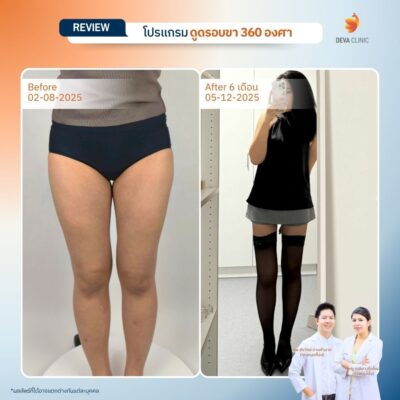 รีวิวดูดไขมันขาใหญ่กรรมพันธุ์ before after 17
