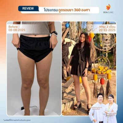 รีวิวดูดไขมันขาตะเกียบ 8