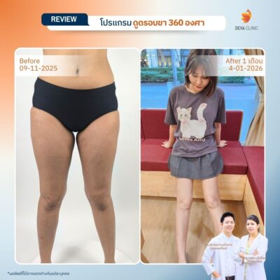 รีวิวดูดไขมันขาใหญ่กรรมพันธุ์ before after 19
