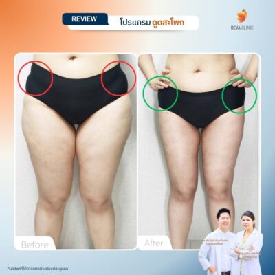 รีวิวดูดสะโพก 7