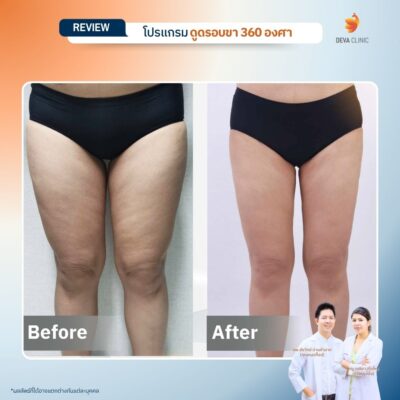 รีวิวลดเซลลูไลท์ต้นขา-ดูดไขมันต้นขา-devaclinic 16