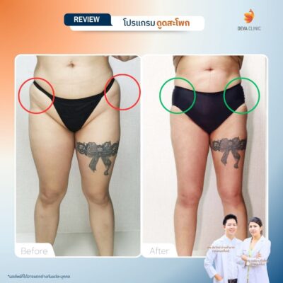 รีวิวดูดสะโพก 1