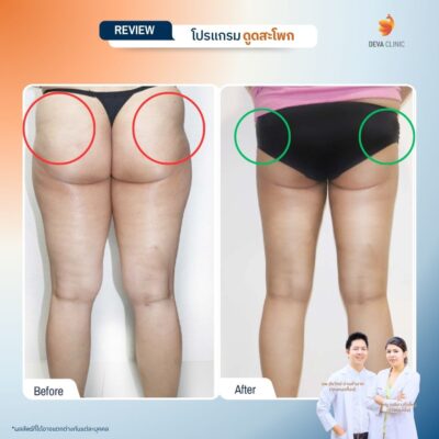 รีวิวดูดสะโพก 4