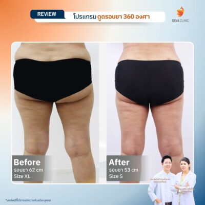 รีวิวลดเซลลูไลท์ต้นขา-ดูดไขมันต้นขา-devaclinic 18