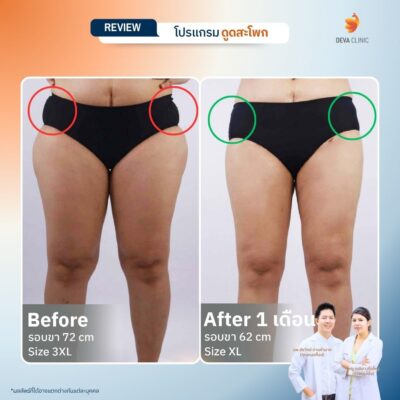 รีวิวดูดสะโพก 2