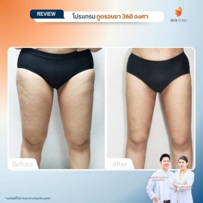 รีวิวลดเซลลูไลท์ต้นขา-ดูดไขมันต้นขา-devaclinic 7