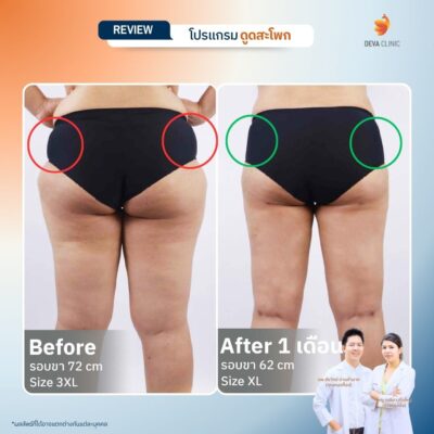 รีวิวดูดสะโพก 5