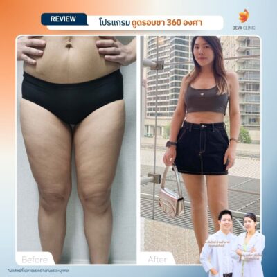 รีวิวลดเซลลูไลท์ต้นขา-ดูดไขมันต้นขา-devaclinic 8