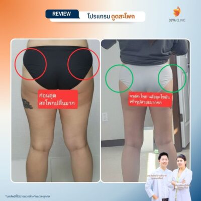 รีวิวดูดสะโพก 6