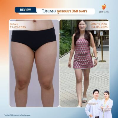 รีวิวดูดไขมันขาตะเกียบ 2