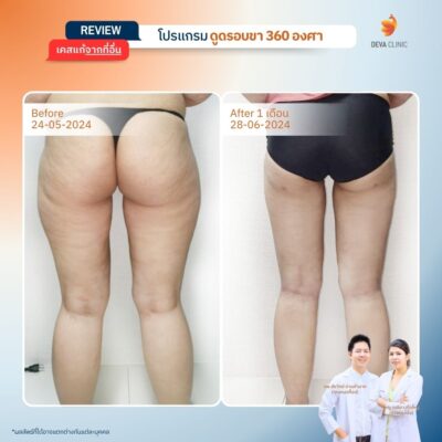 เคสที่ 1: คุณป๊อป – ดูดแค่ขาใน แต่ขากลับดู “ตะปุ่มตะป่ำ” 2