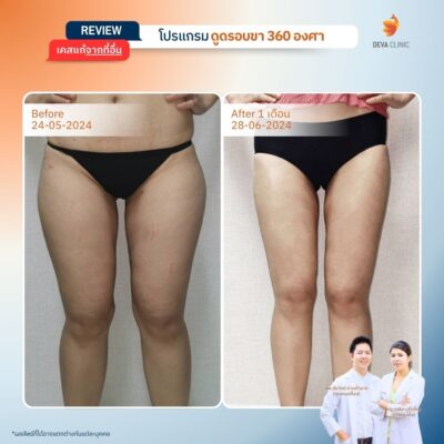 เคสที่ 1: คุณป๊อป – ดูดแค่ขาใน แต่ขากลับดู “ตะปุ่มตะป่ำ” 1