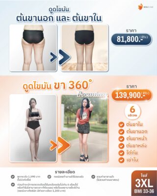 ราคาดูดไขมันต้นขา 3XL