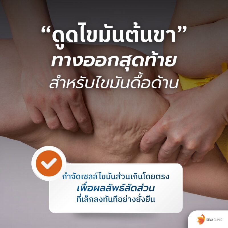 ดูดไขมันต้นขา ทางออกสุดท้ายสำหรับไขมันดื้อด้าน