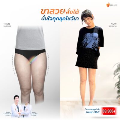 รีวิวดูดไขมันขาใหญ่กรรมพันธุ์ 4