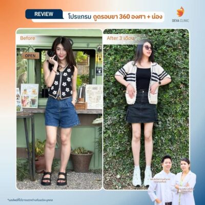 รีวิวดูดไขมันขาตะเกียบ 1
