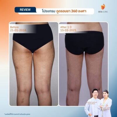 รีวิวดูดไขมันขา ที่ไหนดี 17