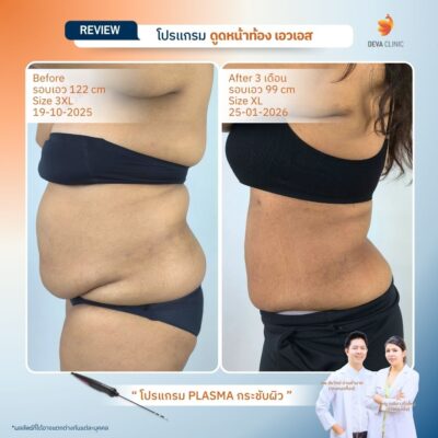 รีวิวก่อนหลังดูดไขมันลดพุง 8