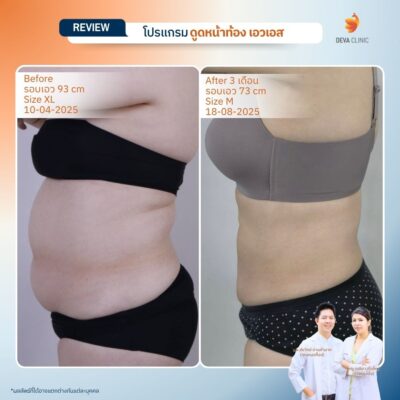 รีวิวดูดไขมันหน้าท้อง รวมรีวิว 10
