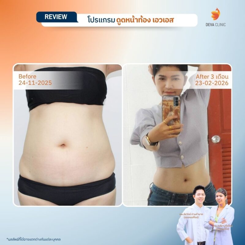รีวิวดูดไขมันเอว หน้าท้อง คุณเดือน มุมหน้ารูปทางบ้าน