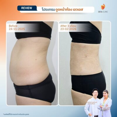 รีวิวผลลัพธ์ ก่อน-หลังจากเคสจริง ดูดไขมัน หน้าท้องล่างป่อง 7