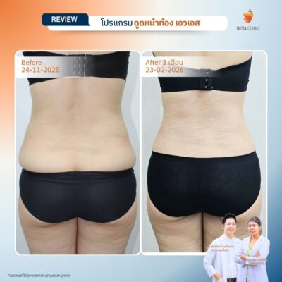 รีวิวดูดไขมันหน้าท้อง รวมรีวิว 12