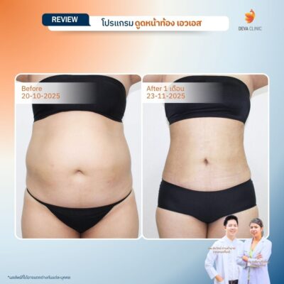 รีวิวผลลัพธ์ ก่อน-หลังจากเคสจริง ดูดไขมัน หน้าท้องล่างป่อง 9