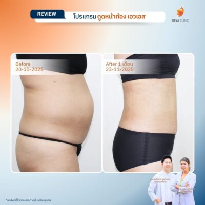 รีวิวดูดไขมันเอว หน้าท้อง คุณทราย มุมข้าง