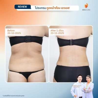 รีวิวดูดไขมันปีกข้าง ก่อนหลัง 13
