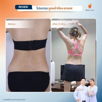 รีวิวก่อนหลังทำ คุณกล้วยไม้ 4