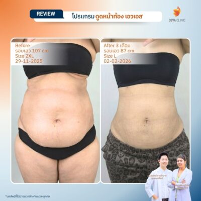 รีวิวก่อนหลัง ดูดไขมันหน้ท้อง เอวเอส 1