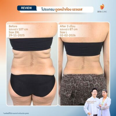 รีวิวดูดไขมันปีกข้าง ก่อนหลัง 2