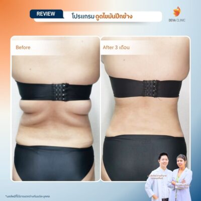 รีวิวดูดไขมันปีกข้าง ก่อนหลัง 1