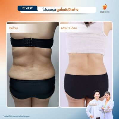 รีวิวดูดไขมันปีกข้าง ก่อนหลัง 7