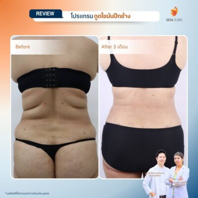 รีวิวดูดไขมันปีกข้าง ก่อนหลัง 3