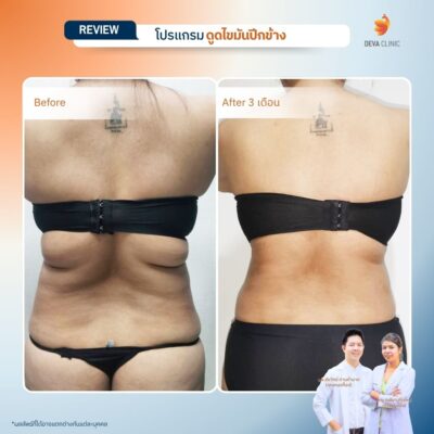 รีวิวดูดไขมันปีกข้าง ก่อนหลัง 4