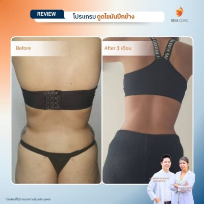 รีวิวดูดไขมันปีกข้าง ก่อนหลัง 14