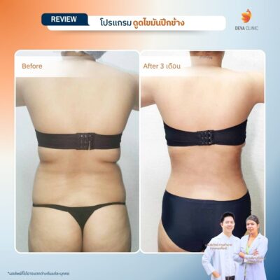 รีวิวดูดไขมันปีกข้าง ก่อนหลัง 8