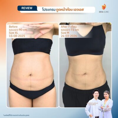 รีวิวก่อนหลัง ดูดไขมันหน้ท้อง เอวเอส 2