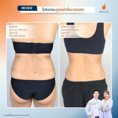 รีวิวก่อนหลัง ดูดไขมันหน้ท้อง เอวเอส 4