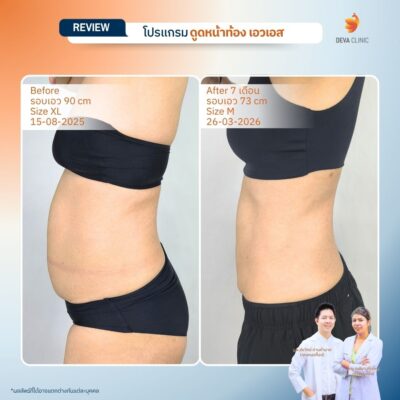 รีวิวผลลัพธ์ ก่อน-หลังจากเคสจริง ดูดไขมัน หน้าท้องล่างป่อง 2