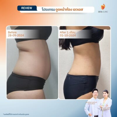 รีวิวดูดไขมันหน้าท้อง รวมรีวิว 20