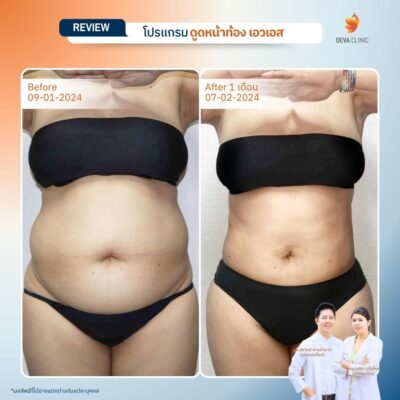 รีวิวดูดไขมันหน้าท้อง รวมรีวิว 21